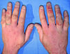Gelure des mains