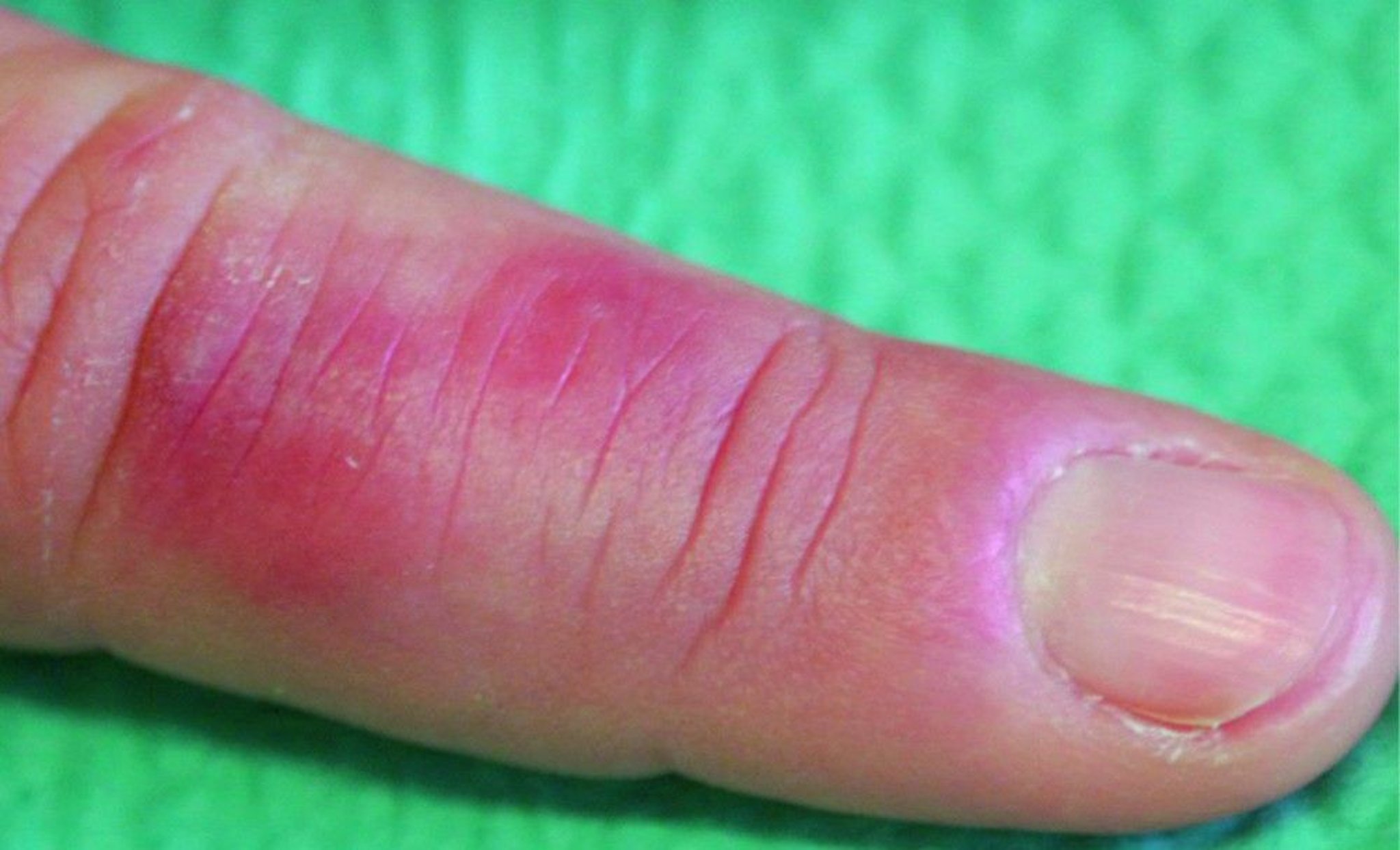 Chilblains (Pernio) (Finger)