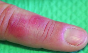 Отморожение первой степени (ознобление) (Палец)