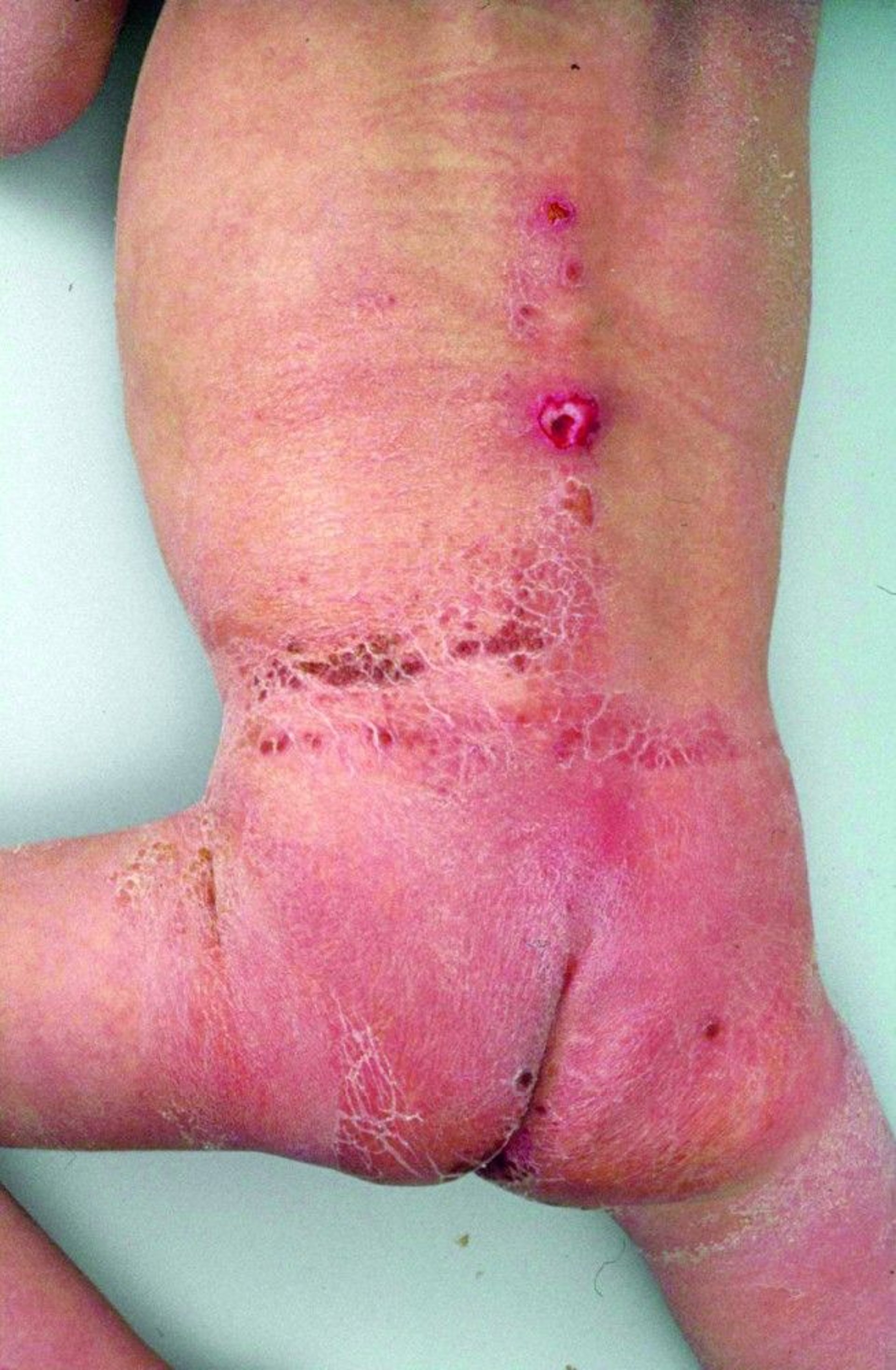 Severe Diaper Rash Due to Neglect