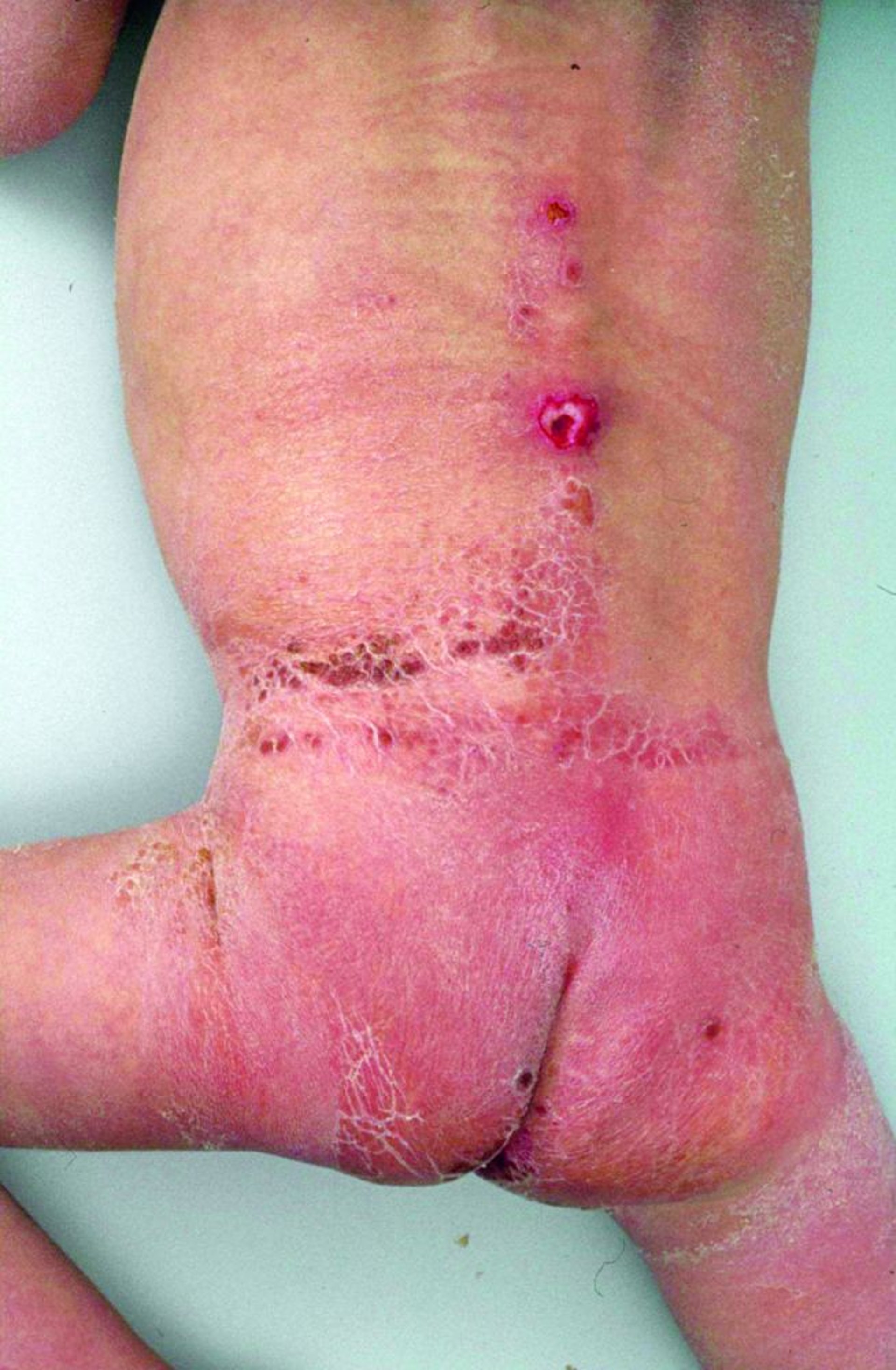 Schwerer Windelausschlag aufgrund von Vernachlässigung