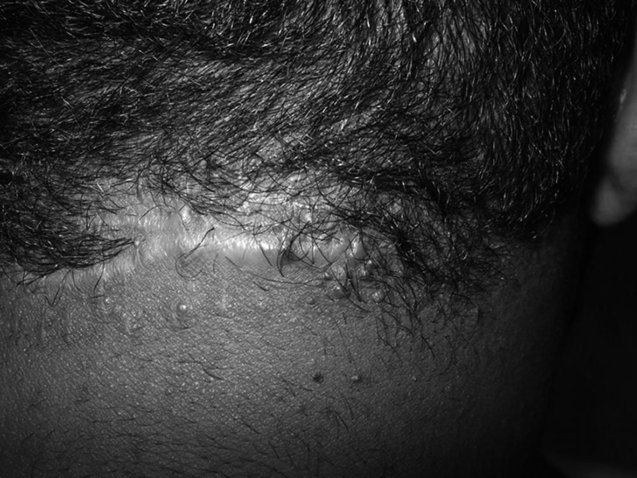 Acne queloidiana da nuca