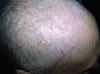 Anagen effluvium indotto da chemioterapia