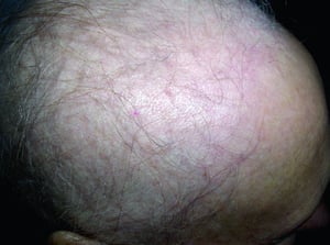 化学療法による成長期脱毛