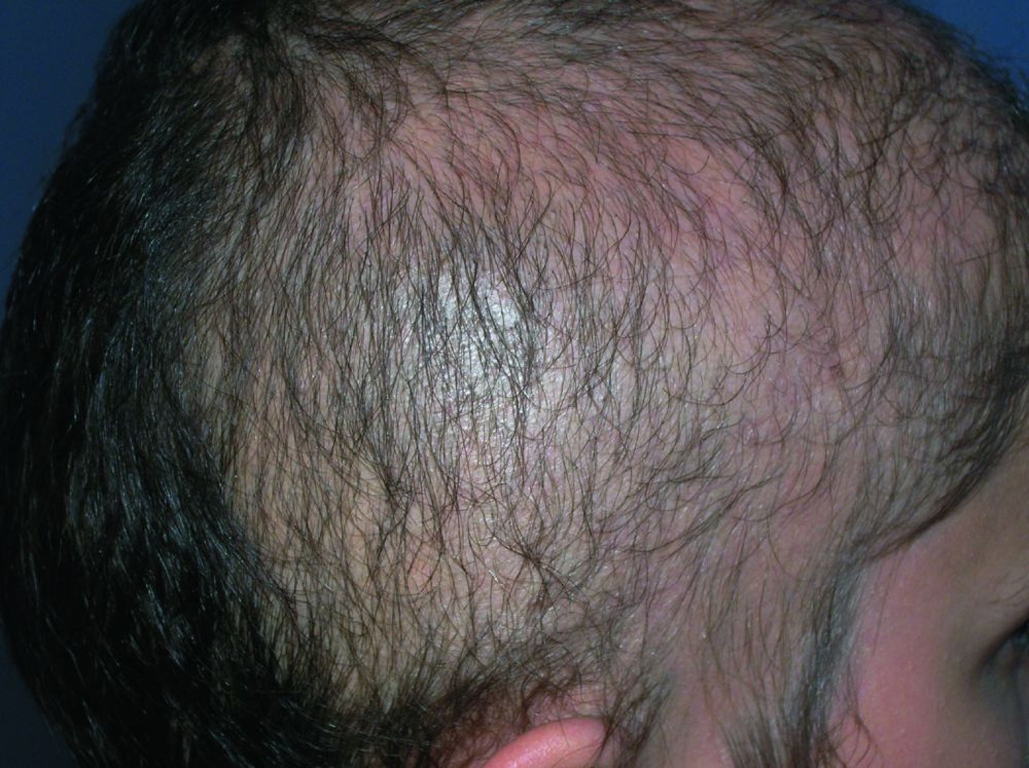 Trichotillomania