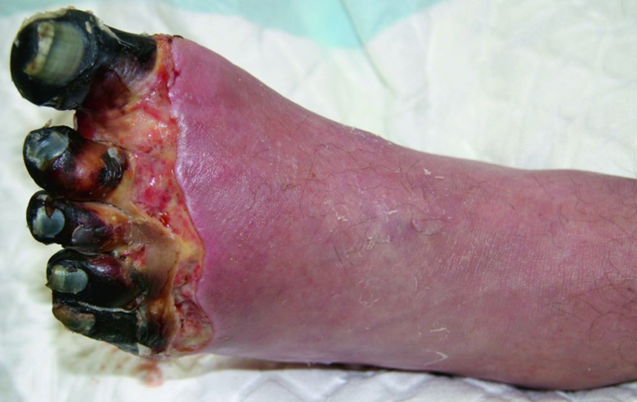 Congelación grave del pie con necrosis de los dedos de los pies