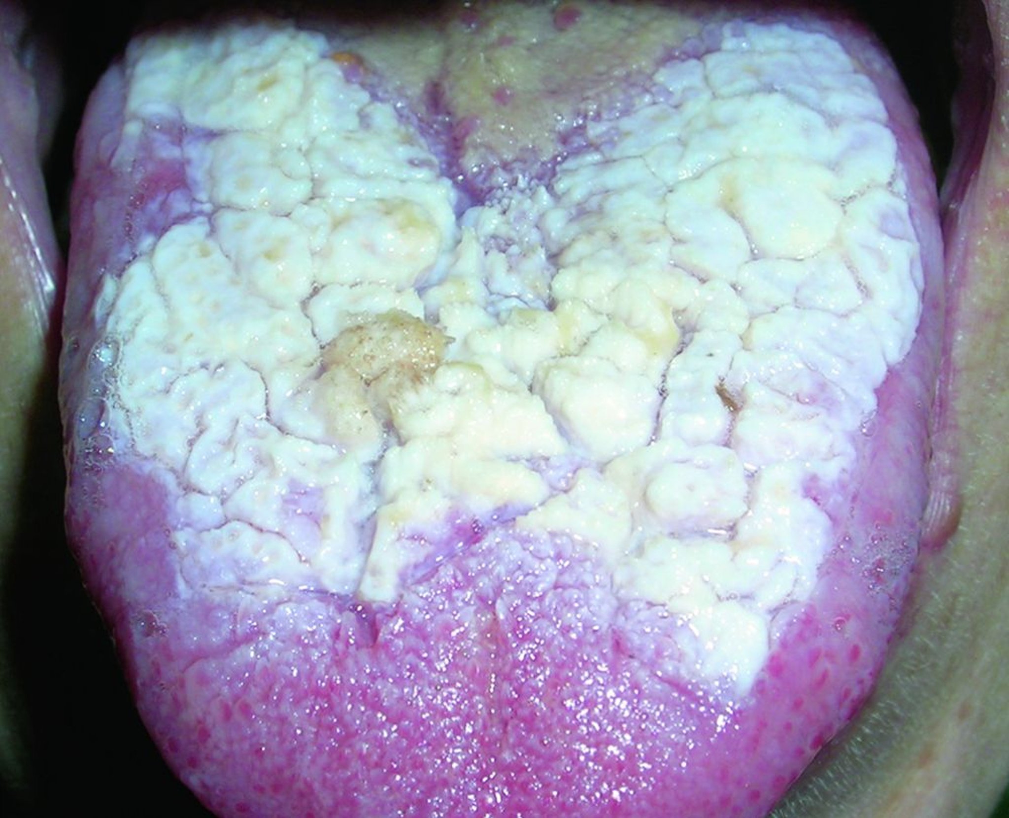 Лейкоплакия