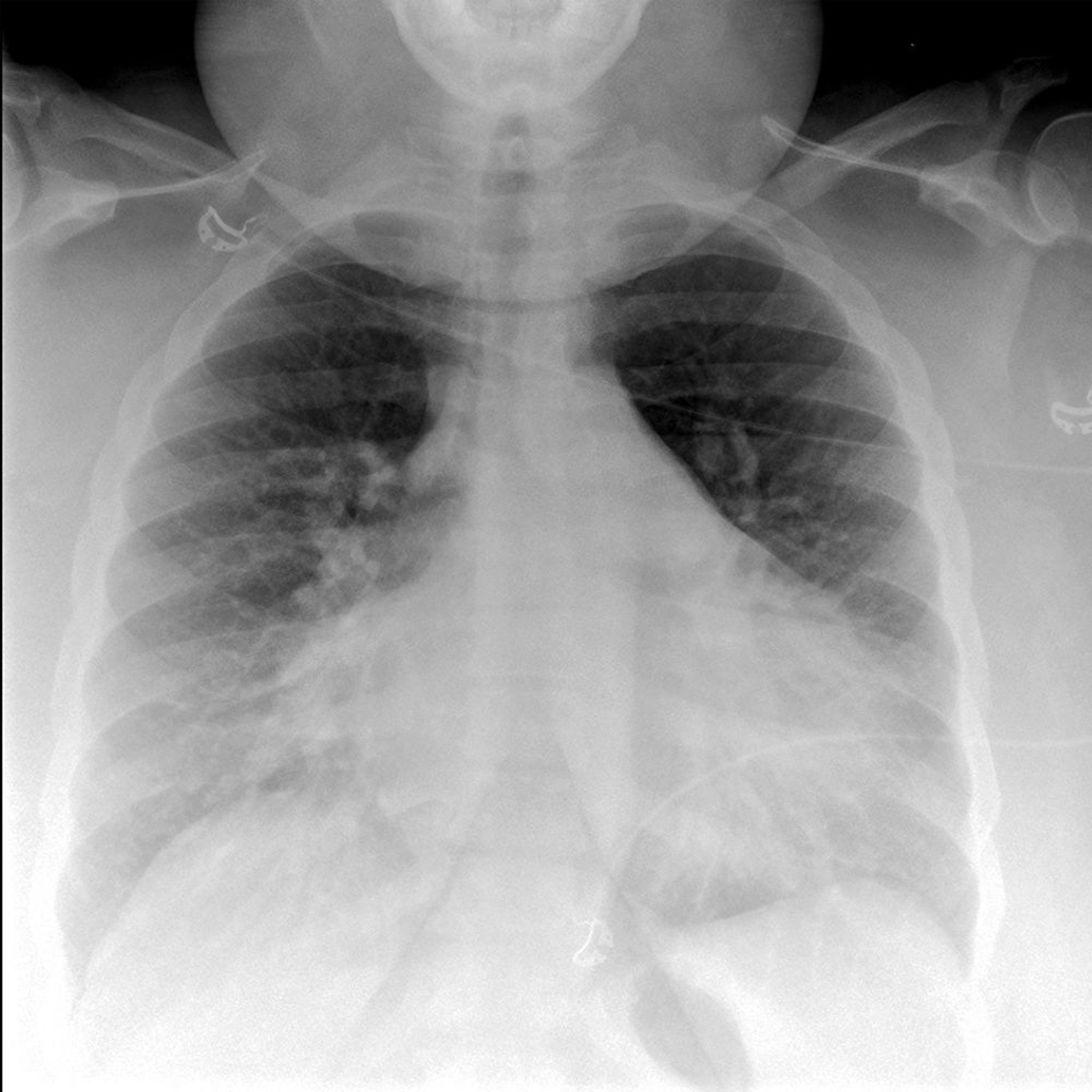 Röntgenaufnahme des Thorax bei einem Patienten mit Lungenödem