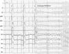 Fibrilación ventricular
