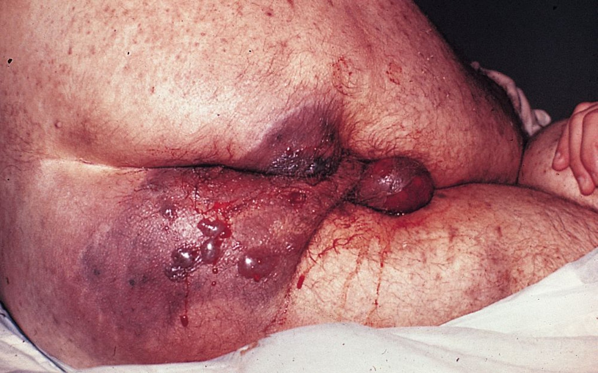 Myonécrose clostridienne (spontanée)