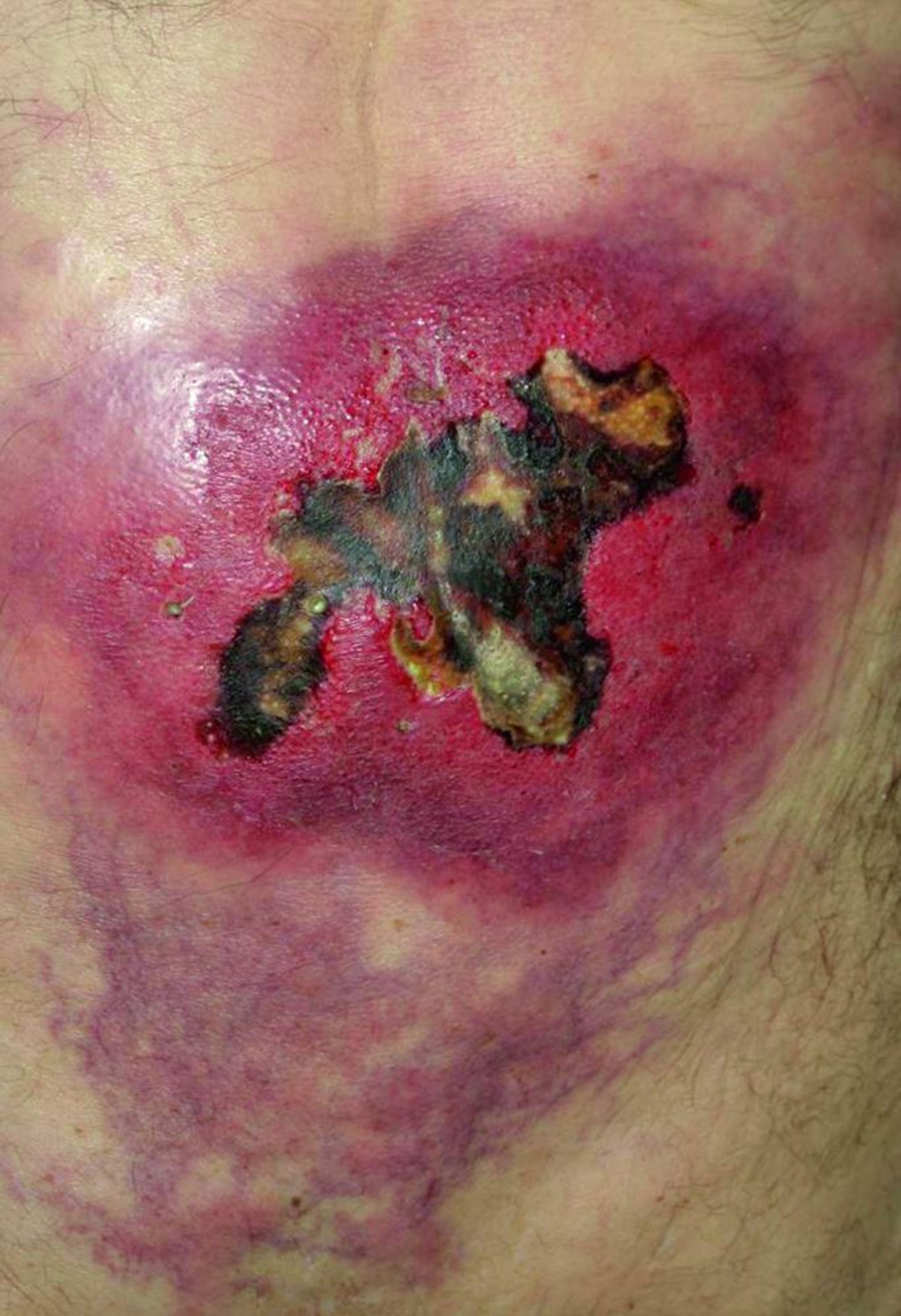 ImageEstreptococos del grupo A (infección necrosante del tejido blando