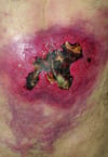 Estreptococos do grupo A (infecção necrosante de tecidos moles)