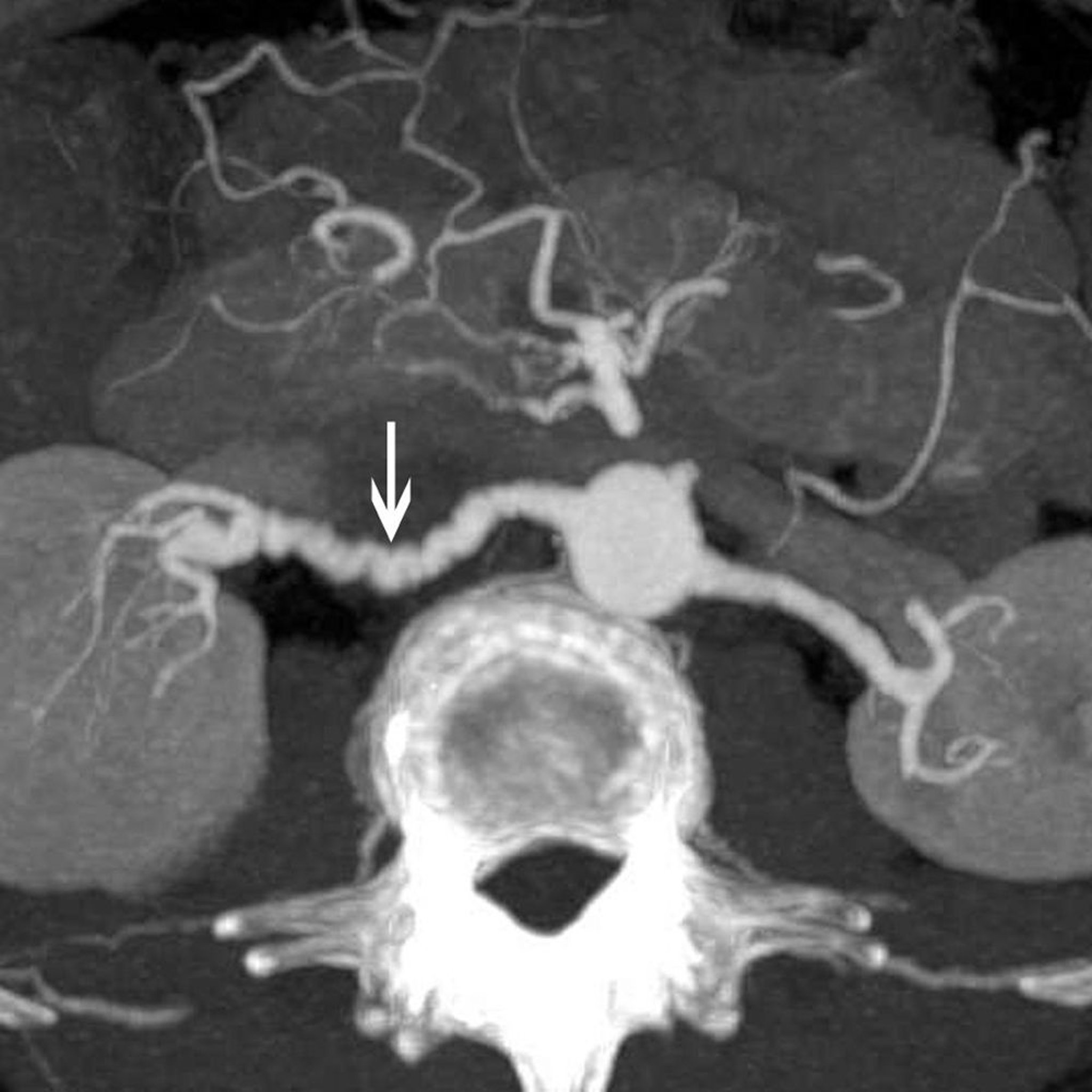 Displasia fibromuscular da artéria renal