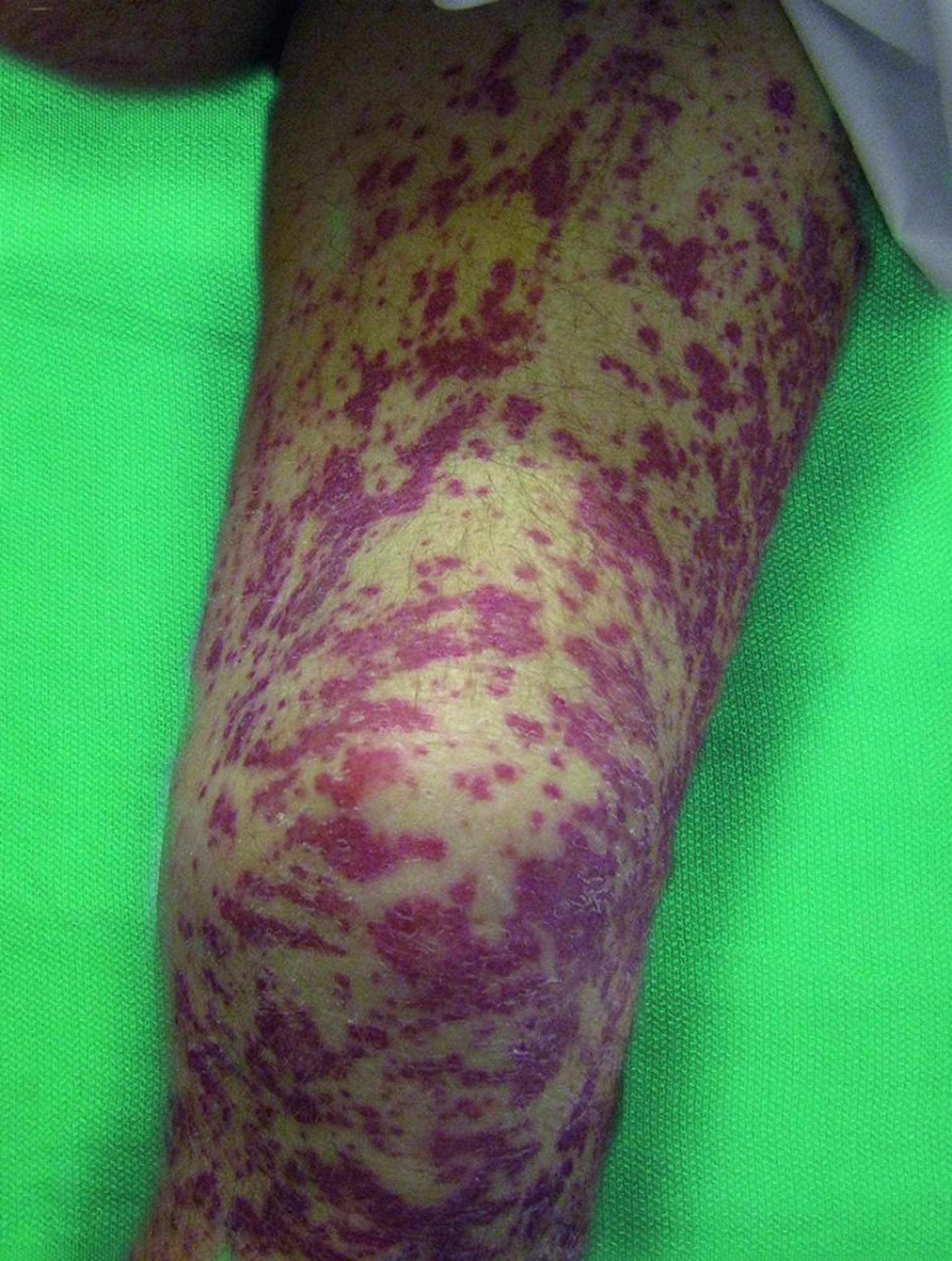 Vasculitis cutánea (extremidad inferior)