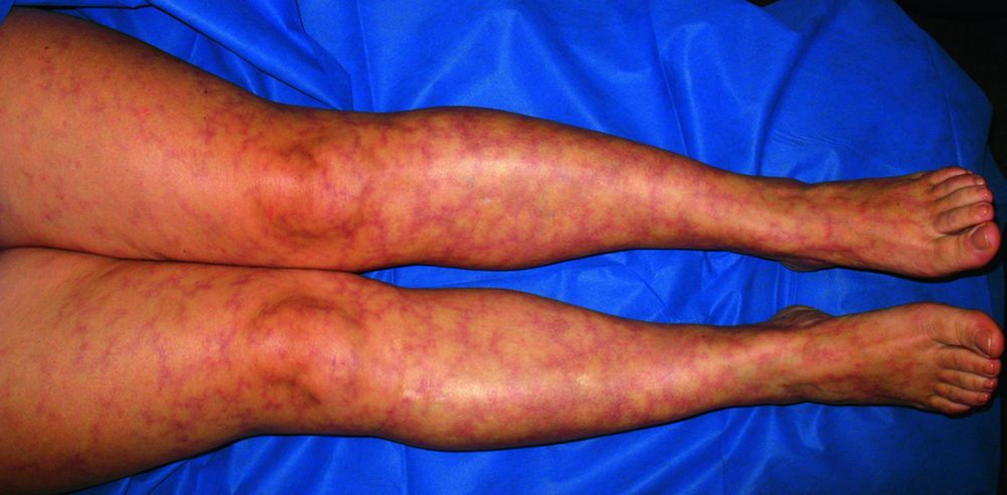 Livedo reticular (Livedo Reticularis)