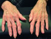 Bouchard Nodes