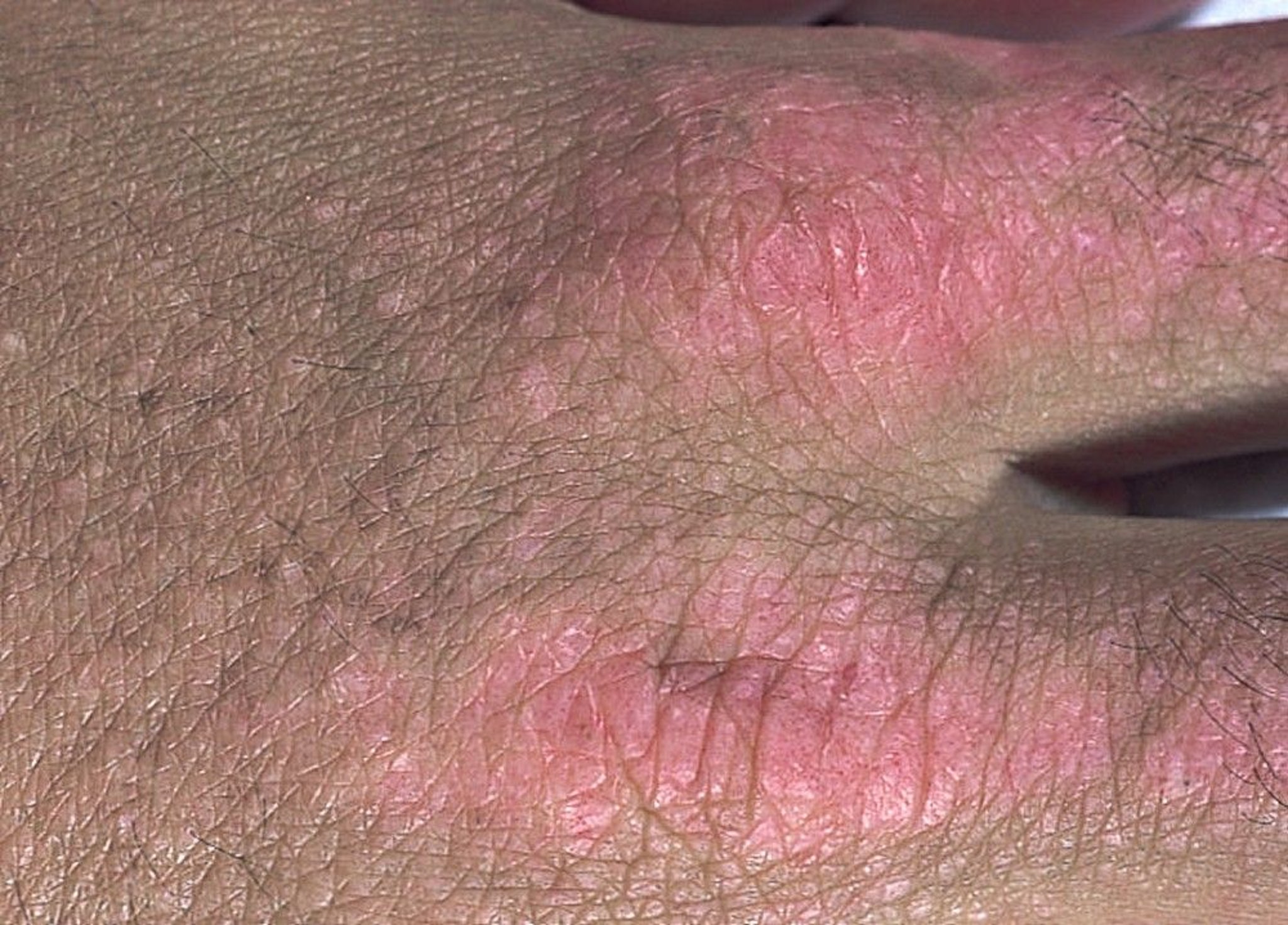 Gottron Papules (1)