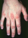 Dermatomyositis (Hand Findings)