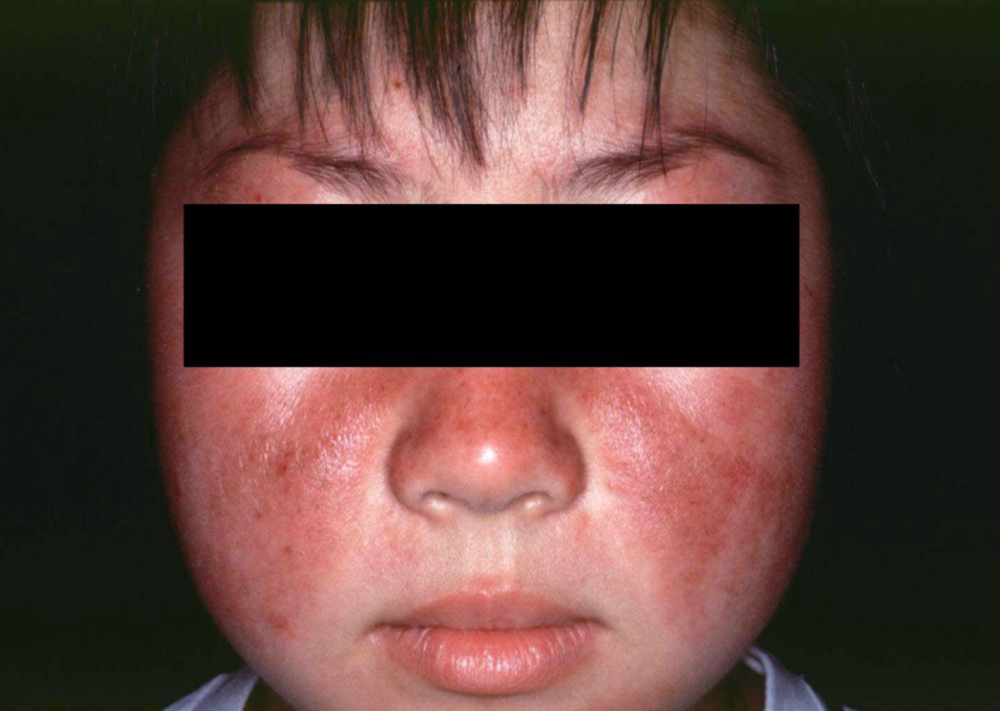 Systemischer Lupus erythematodes (Malariaausschlag)