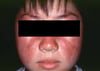 Lupus érythémateux disséminé (éruption malaire)