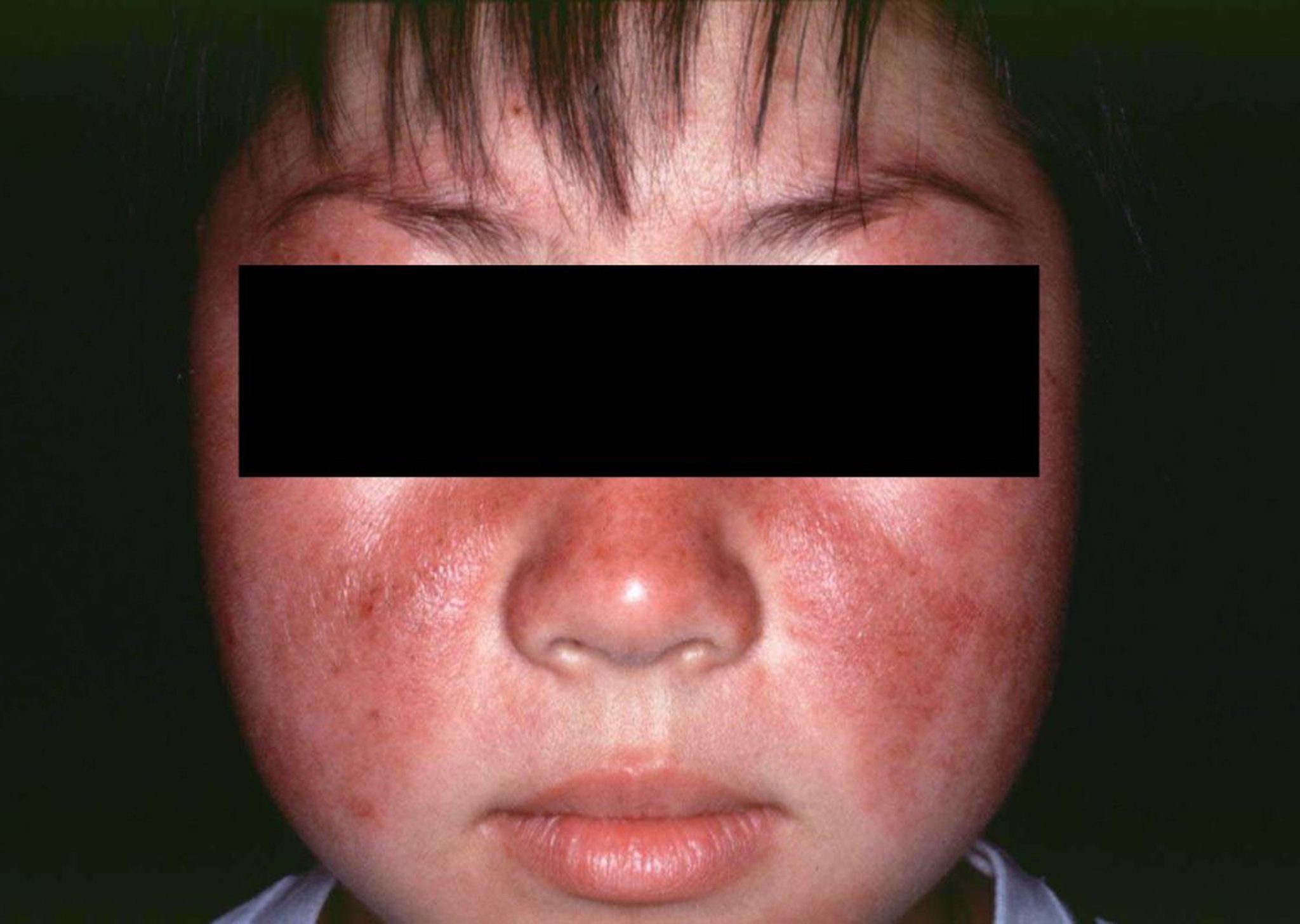 Lupus érythémateux disséminé (éruption malaire)