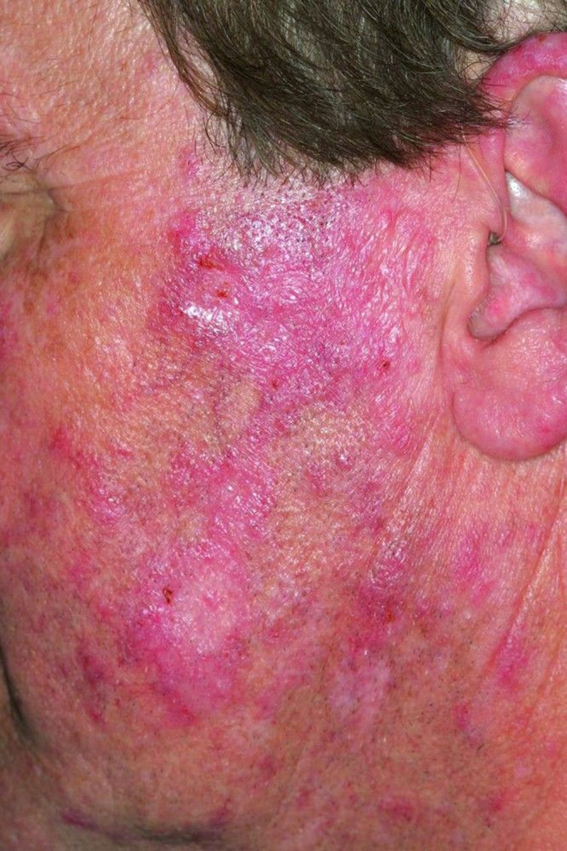 Chronic Discoid Lupus Erythematosus