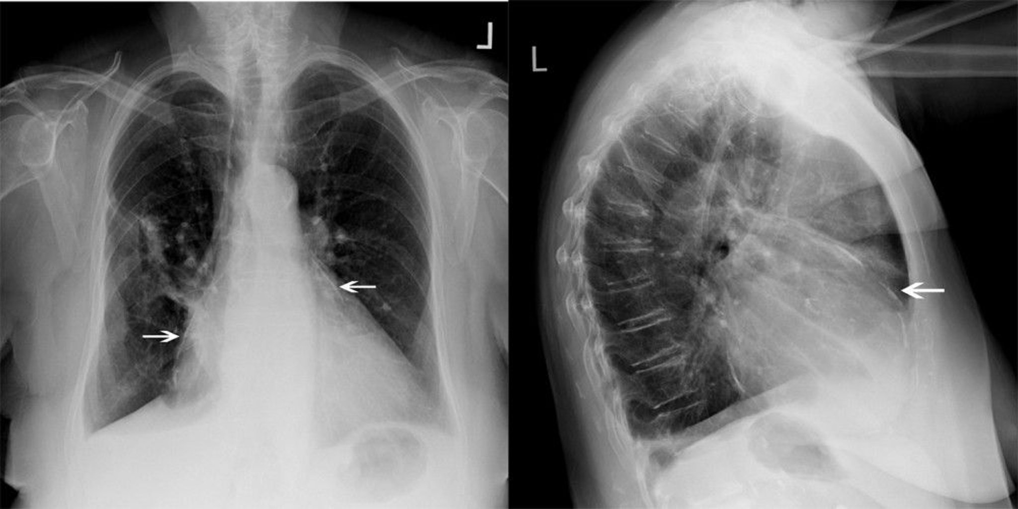 Chest X-Ray of a Patient with Constrictive Pericarditis