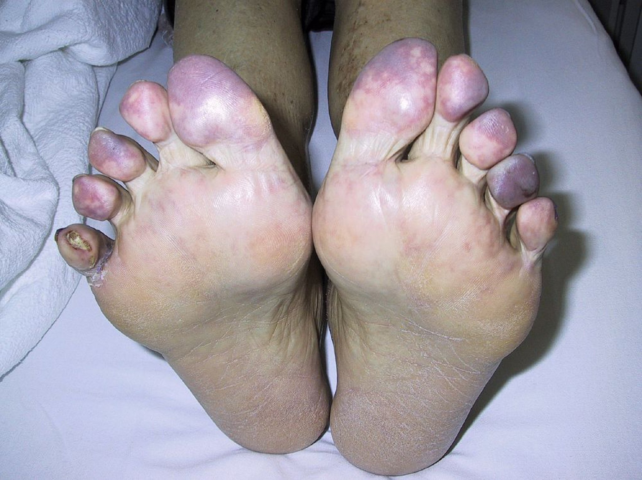 Embolizzazione dei cristalli del colesterolo