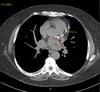 Noncontrast CT Showing Coronary Artery Calcification