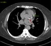 TC sin contraste que muestra calcificación de la arteria coronaria