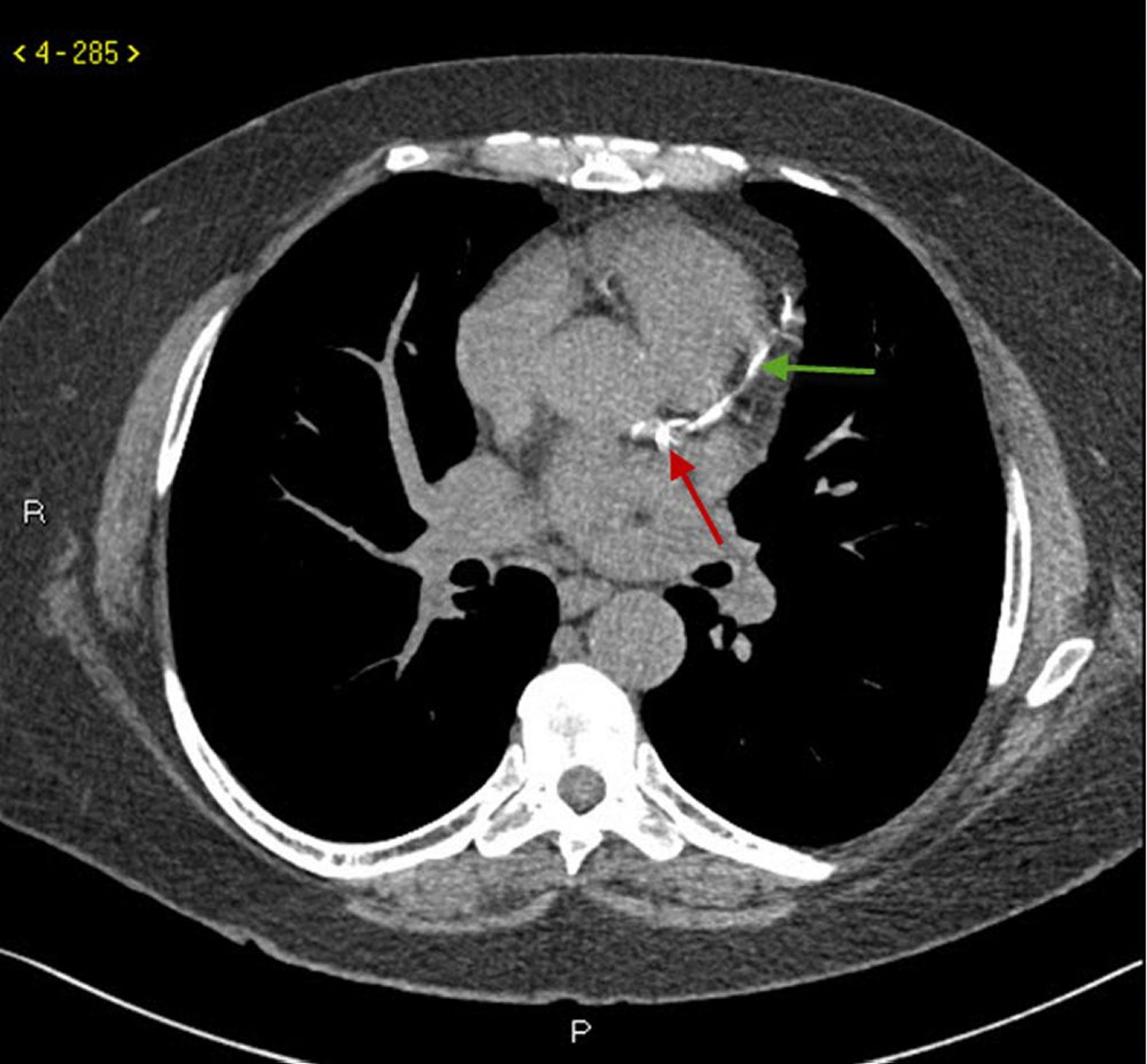 TC sin contraste que muestra calcificación de la arteria coronaria