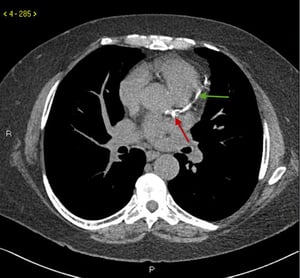 TC sin contraste que muestra calcificación de la arteria coronaria