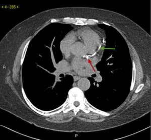 Chụp CT không thuốc cản quang cho thấy vôi hóa động mạch vành