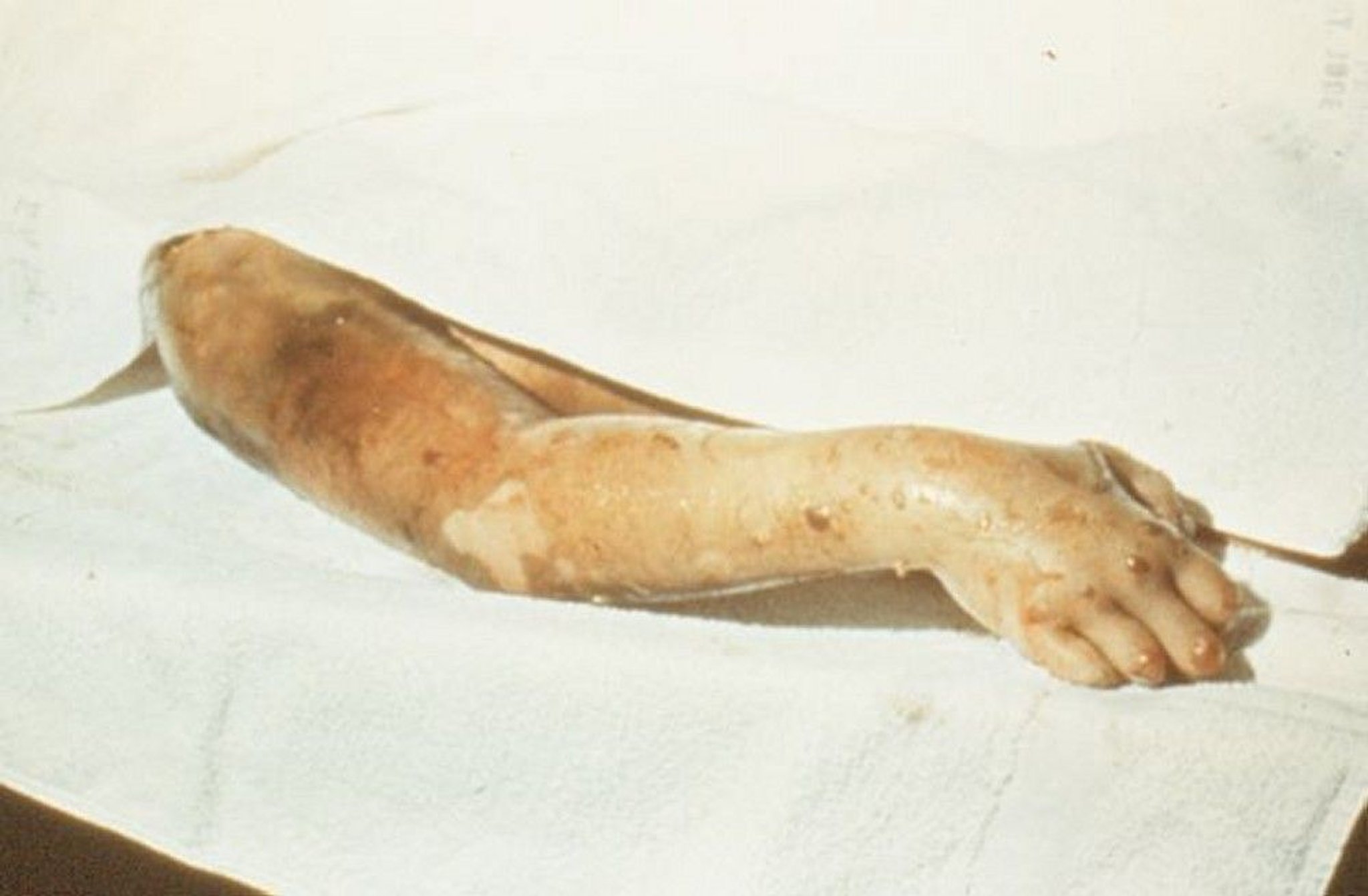 Mionecrose clostridial da gangrena gasosa (traumática)