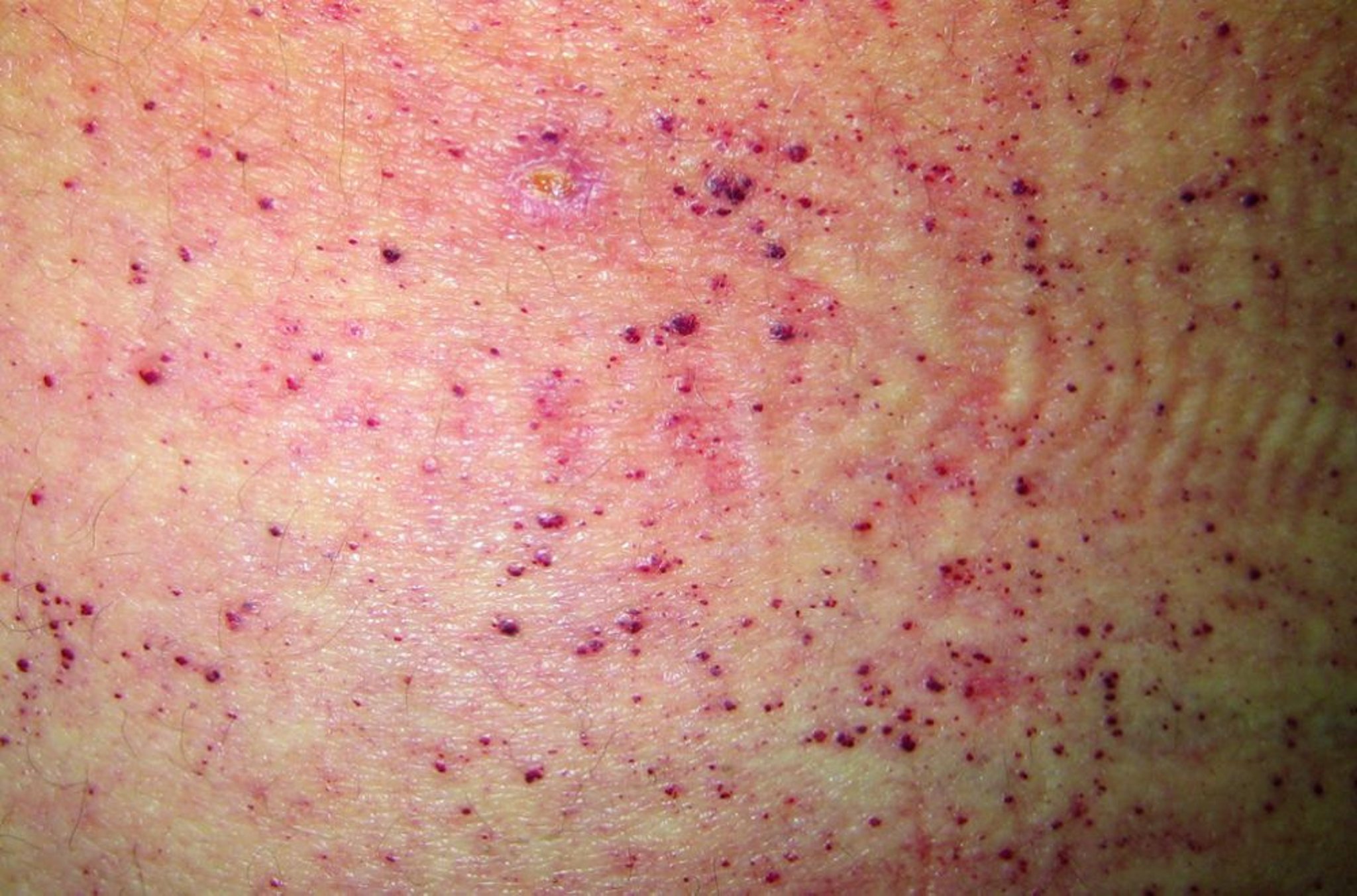 Angiokeratomas in Fabry Disease