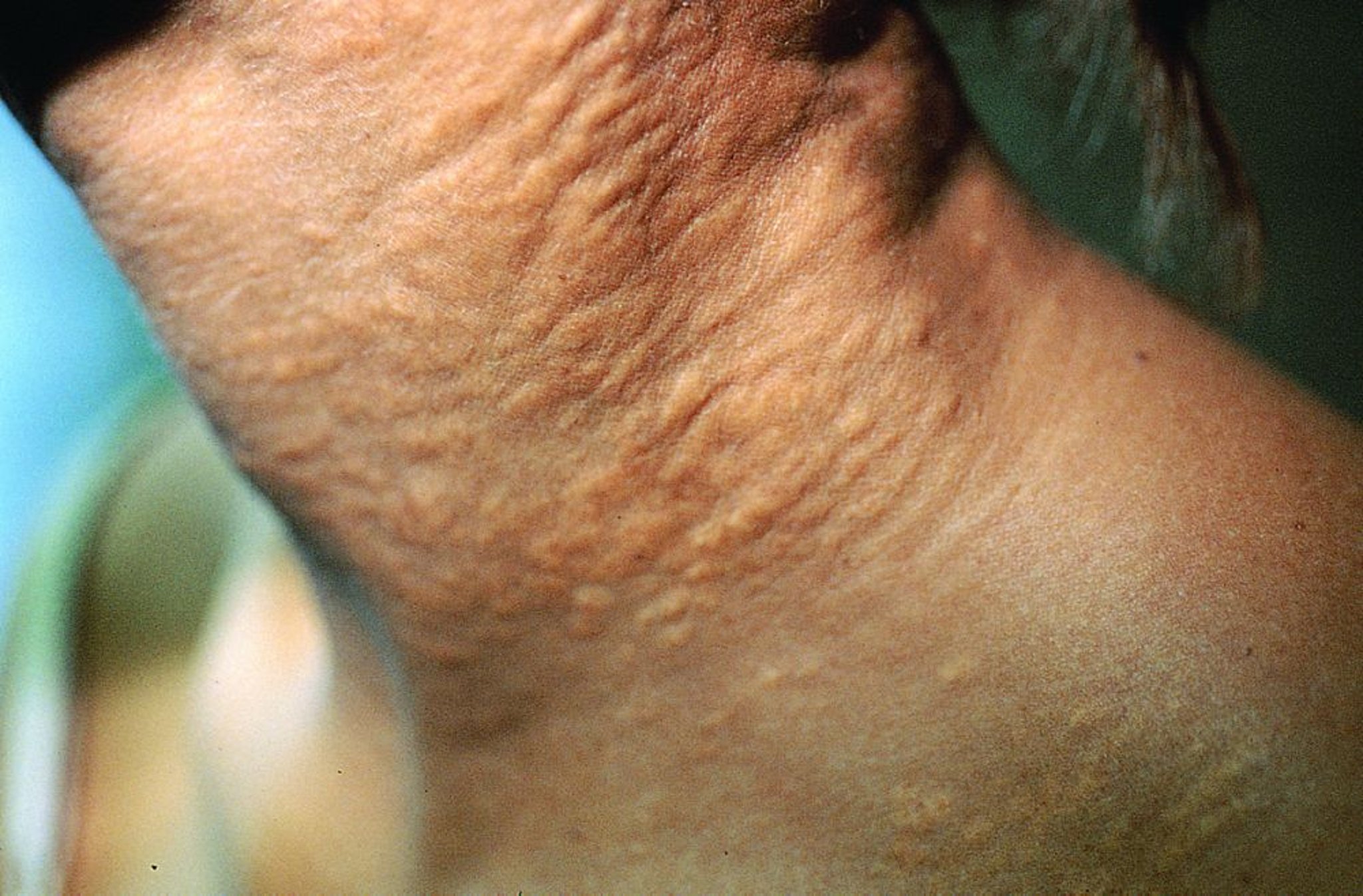 Pseudoxantoma elástico (manifestações cutâneas)