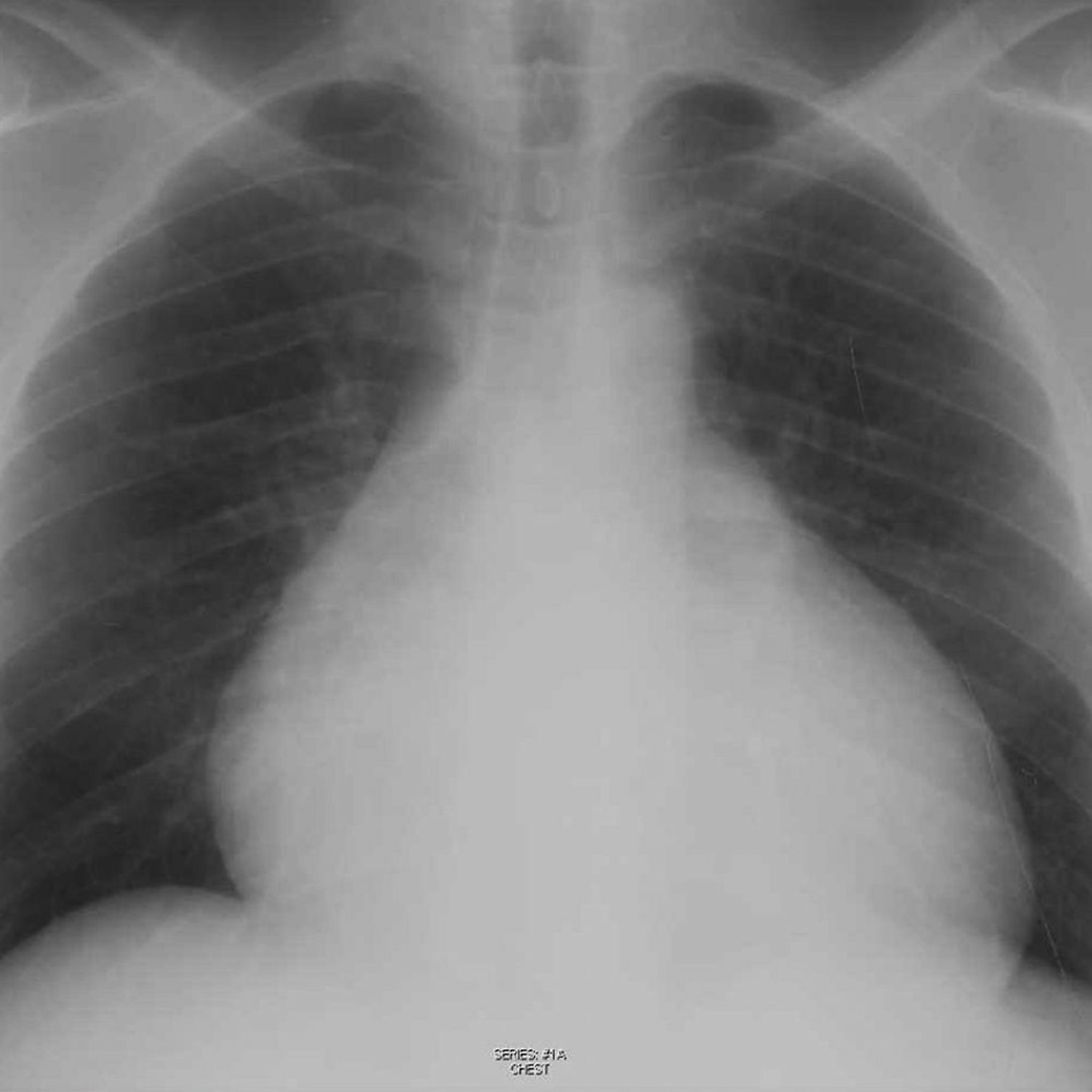 Radiographie pulmonaire d'un patient présentant un épanchement péricardique