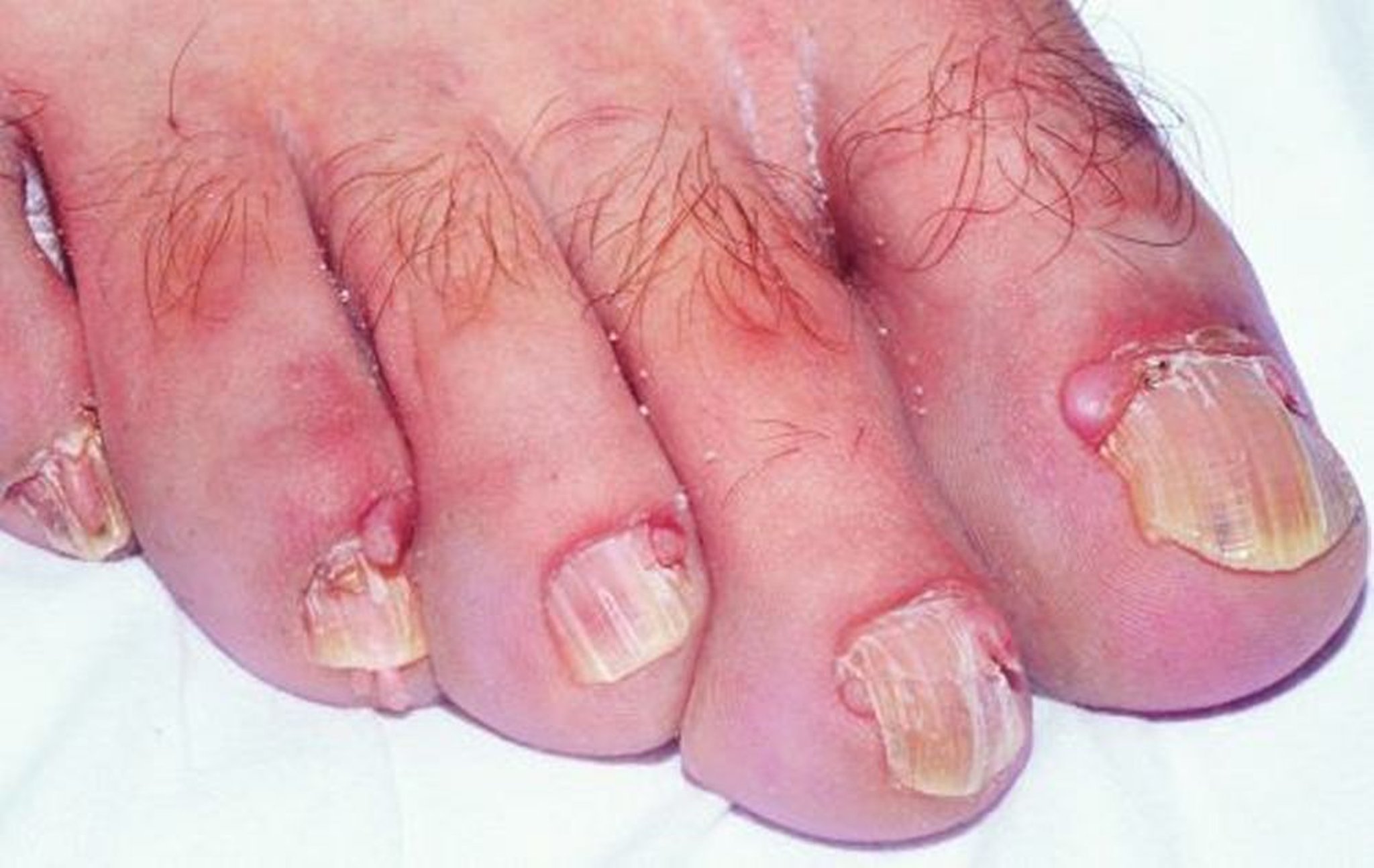 Tumori di Koenen nel complesso della sclerosi tuberosa (sclerosi tuberosa di Bourneville)