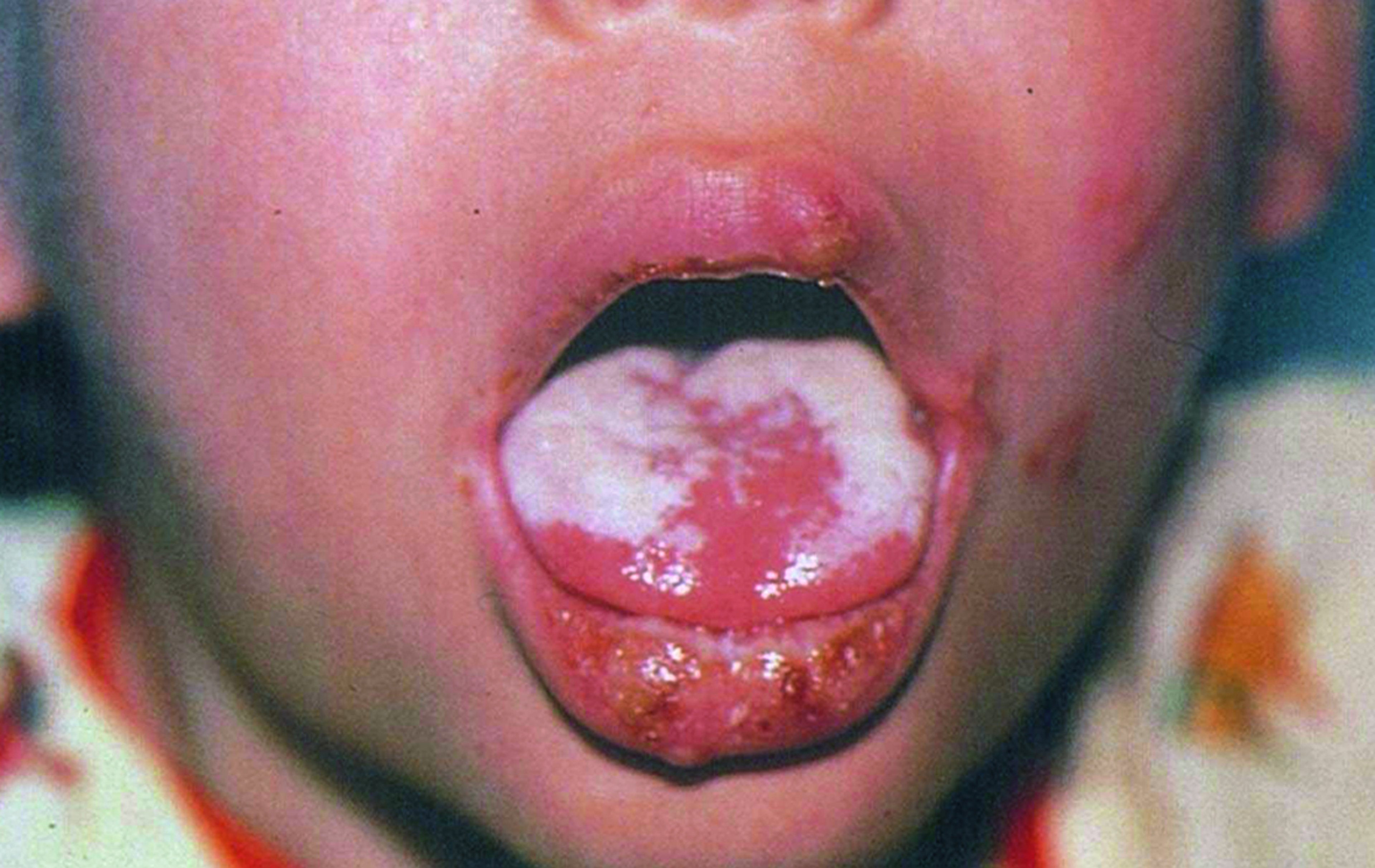 HIV感染による口腔カンジダ症