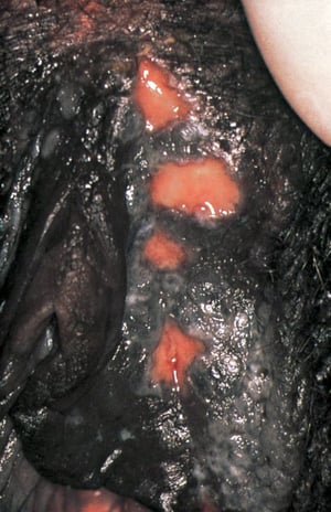 Herpes genitalis (Ulzerationen)