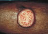 Bệnh do leishmania da