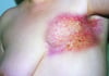 Chronische Radiodermatitis