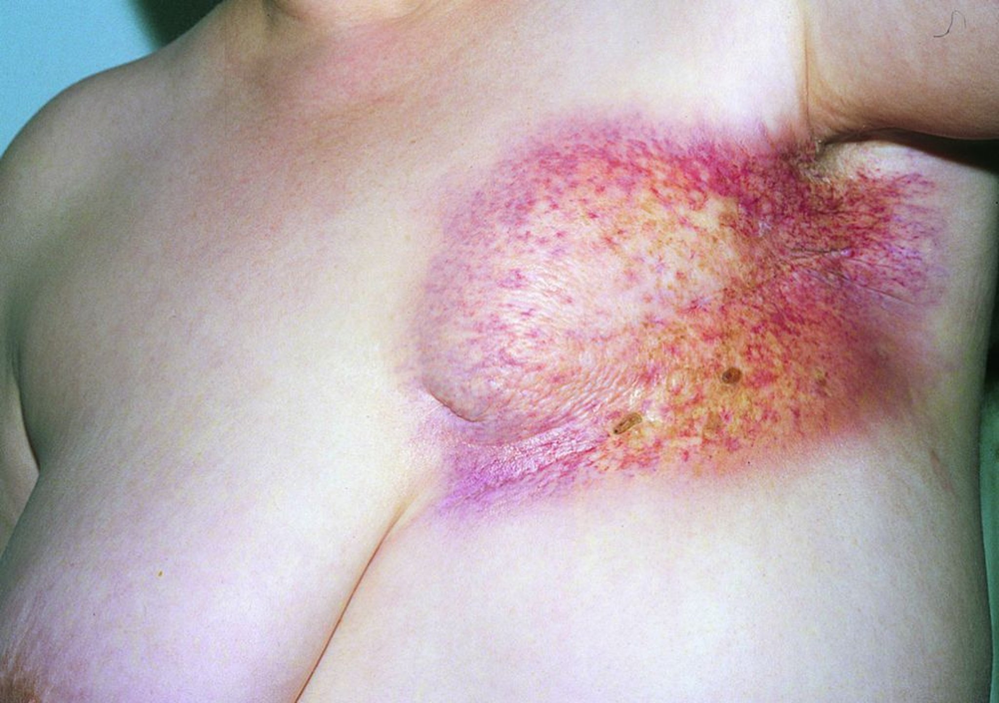 Chronische Radiodermatitis