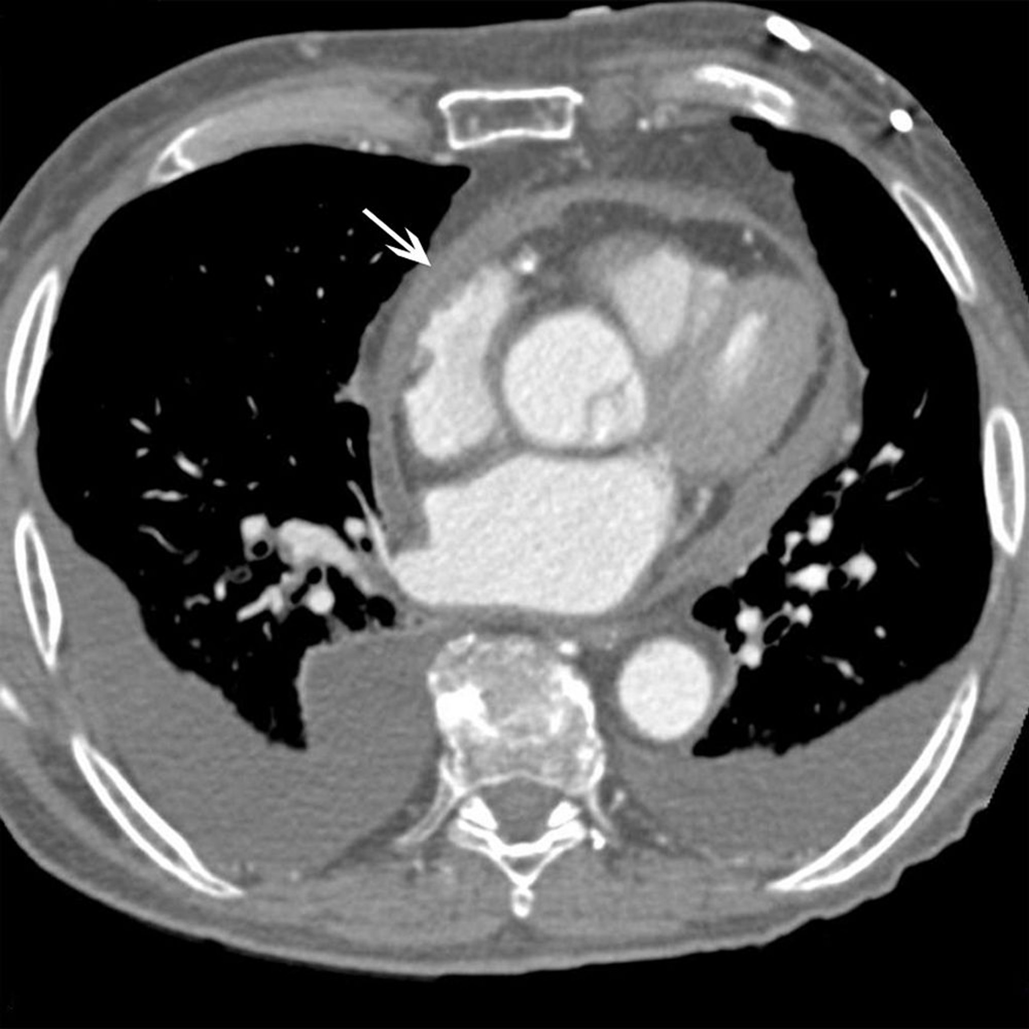 CT của một bệnh nhân bị viêm màng ngoài tim co thắt