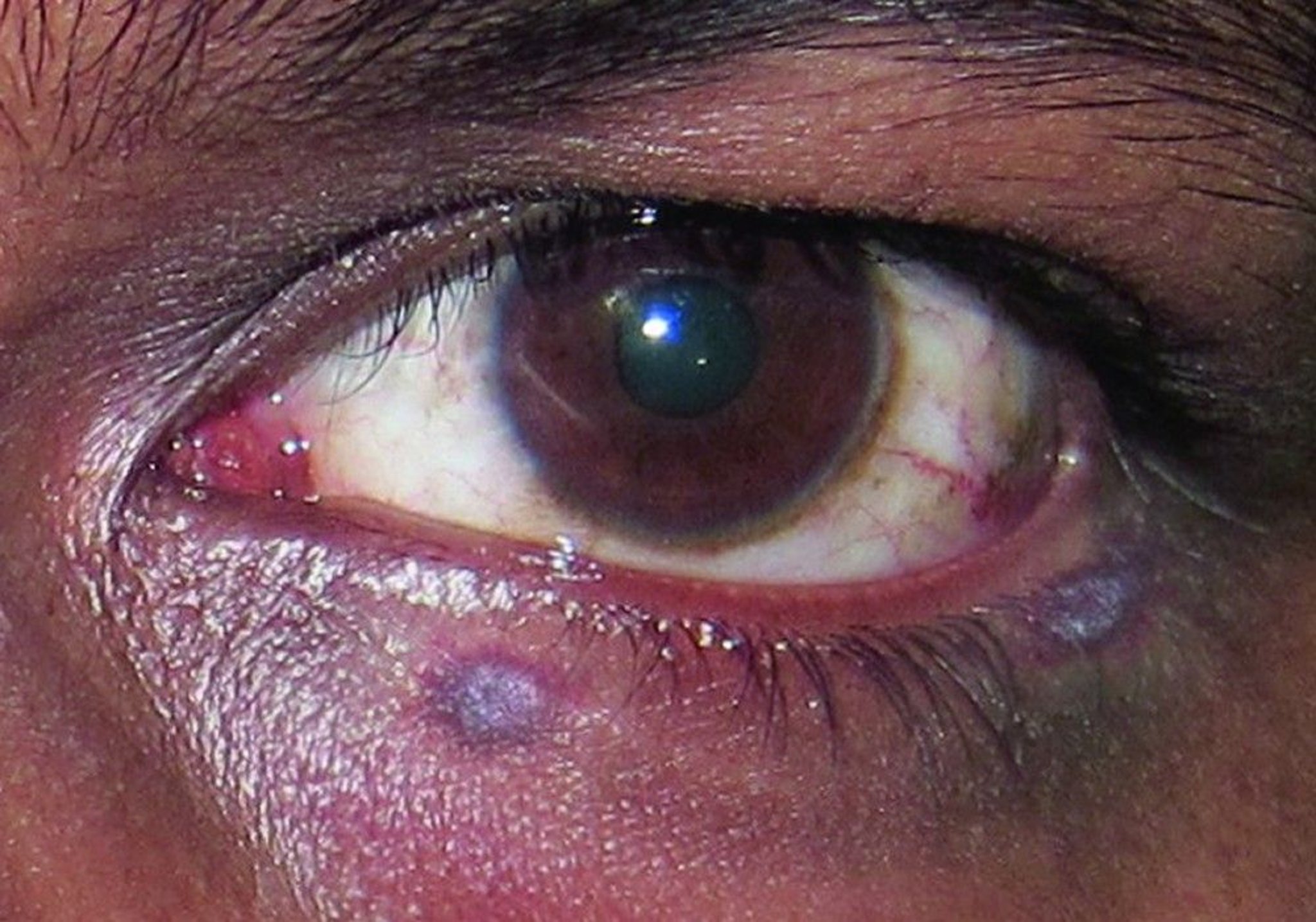 Kaposi Sarcoma (Early Stage)