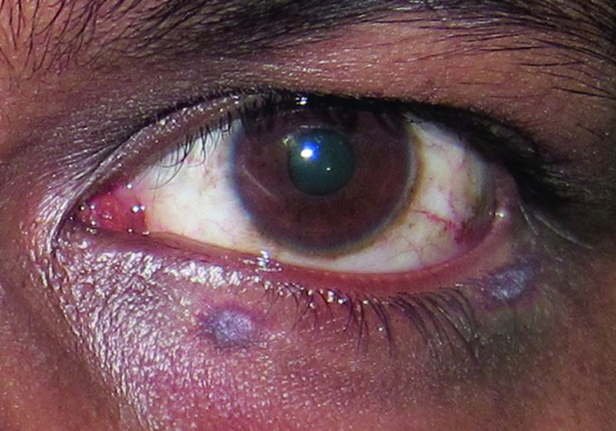 Kaposi Sarcoma (Early Stage)