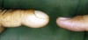 Finger Clubbing