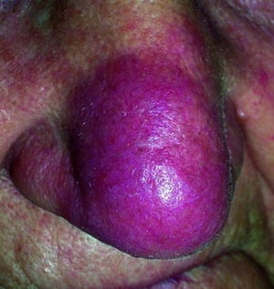 Sarcoidosis (Lupus Pernio)