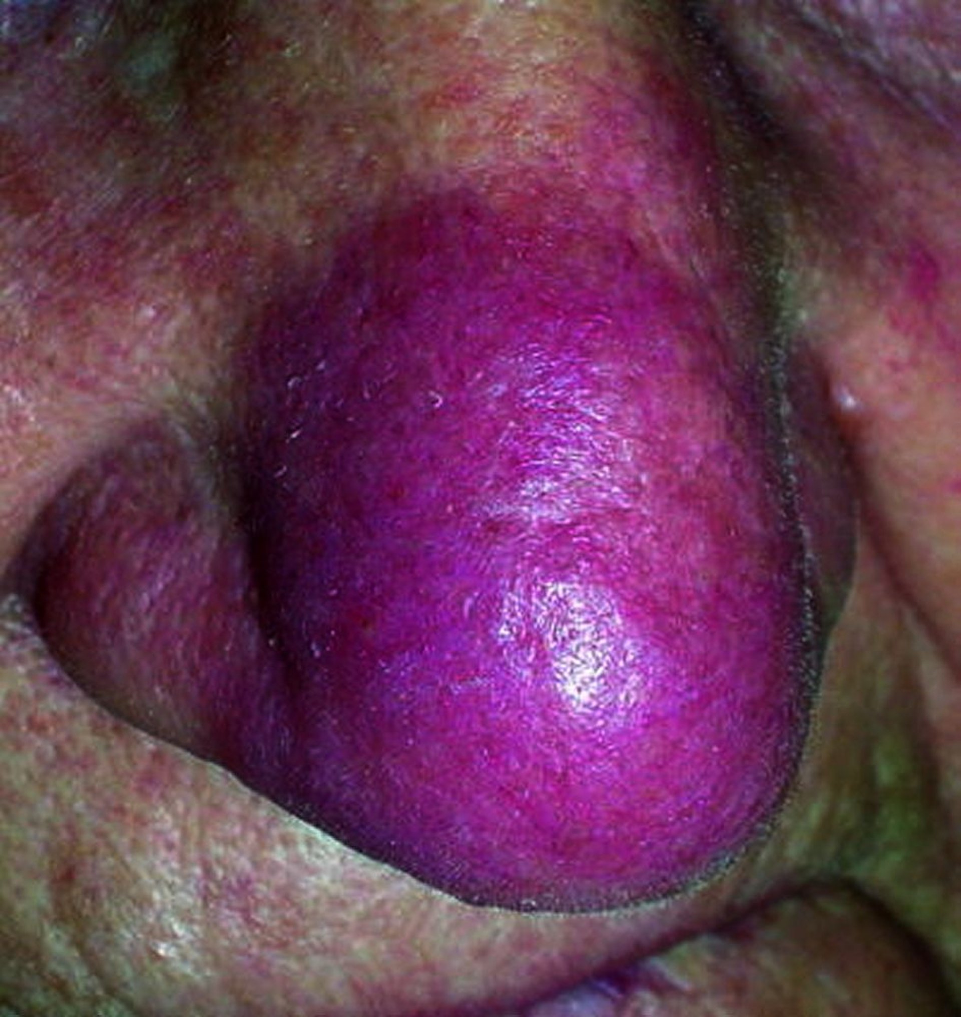 Sarcoidosis cutánea (lupus pernio)