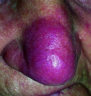 Sarcoidosis (lupus pernio)